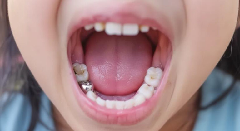 What Are Pediatric Dental Crowns and When Does a Child Need One?